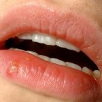 Lūpų pūslelinė (herpes virusas)